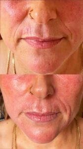 Microneedling Vergleich vorher nachher 2