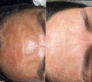 Microneedling bei KVK Cosmetics Vergleich vorher nachher