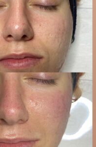 Microneedling Vergleich vorher nachher 3